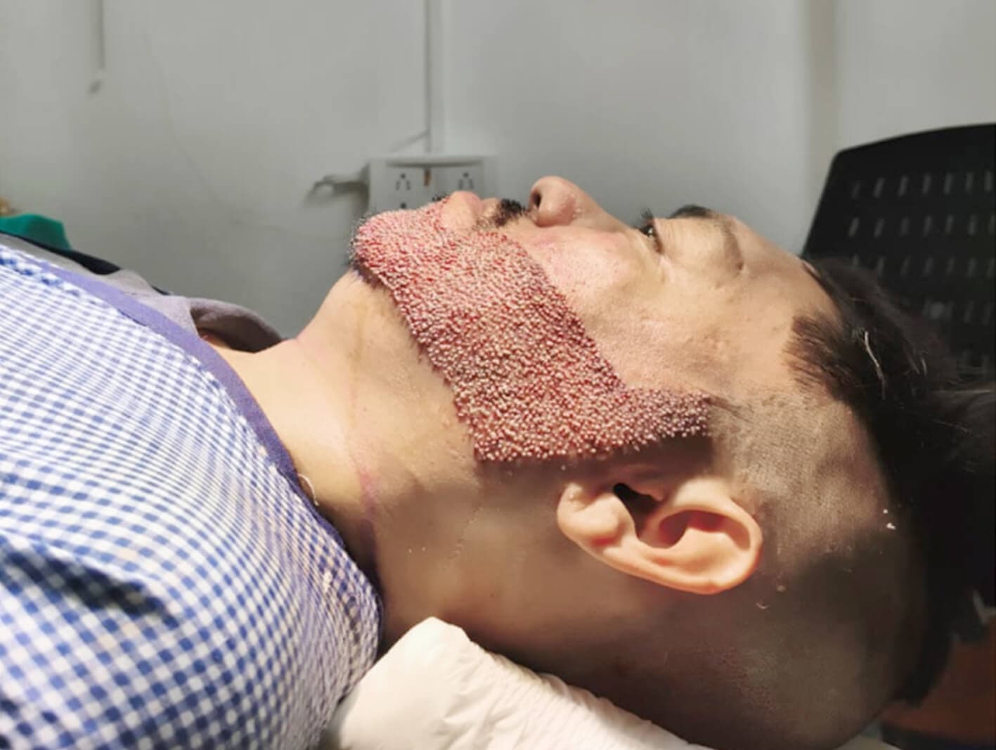 Beard Transplant Success Rate: What Patients Should Expect