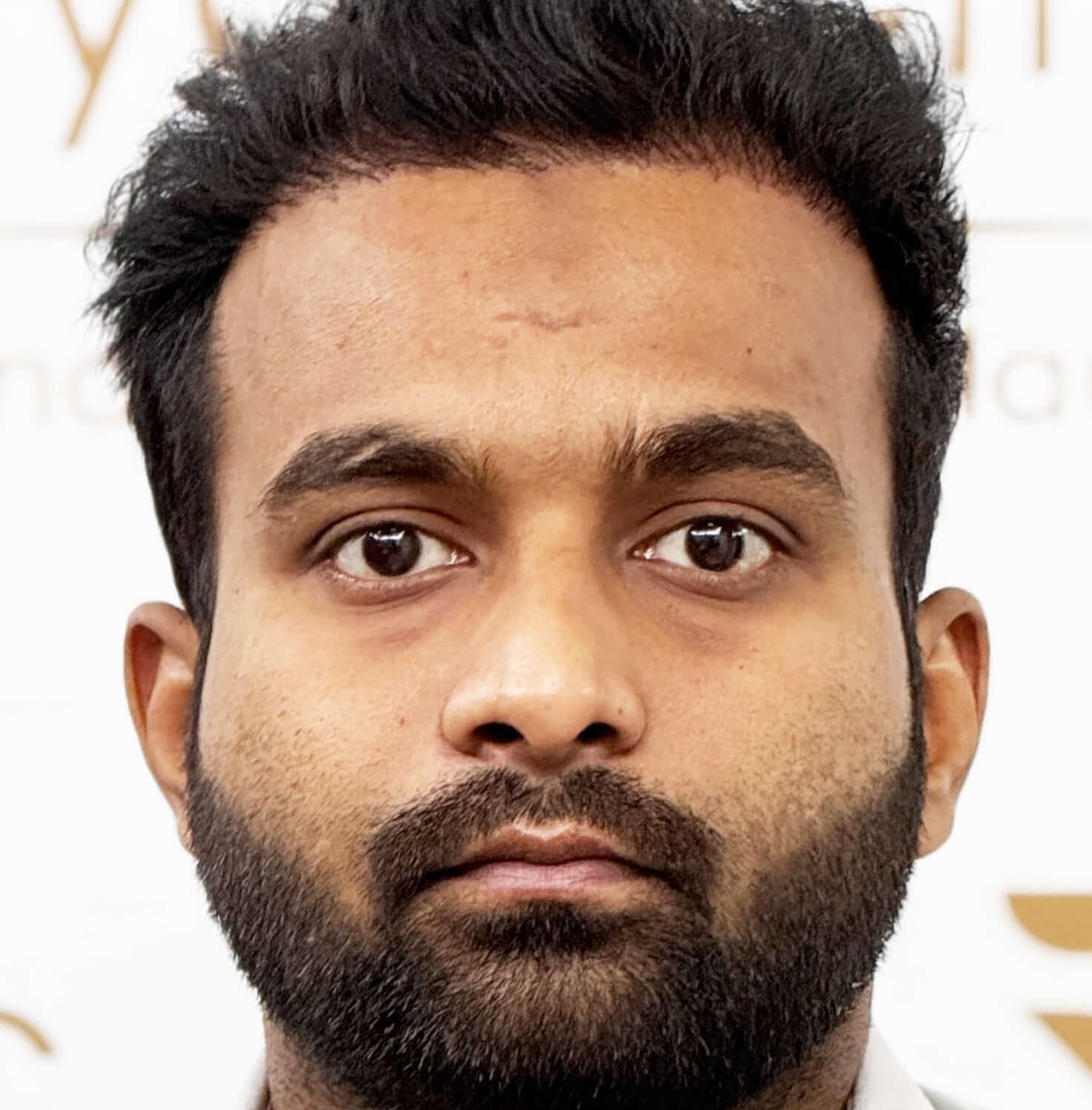 Hair transplant result 13