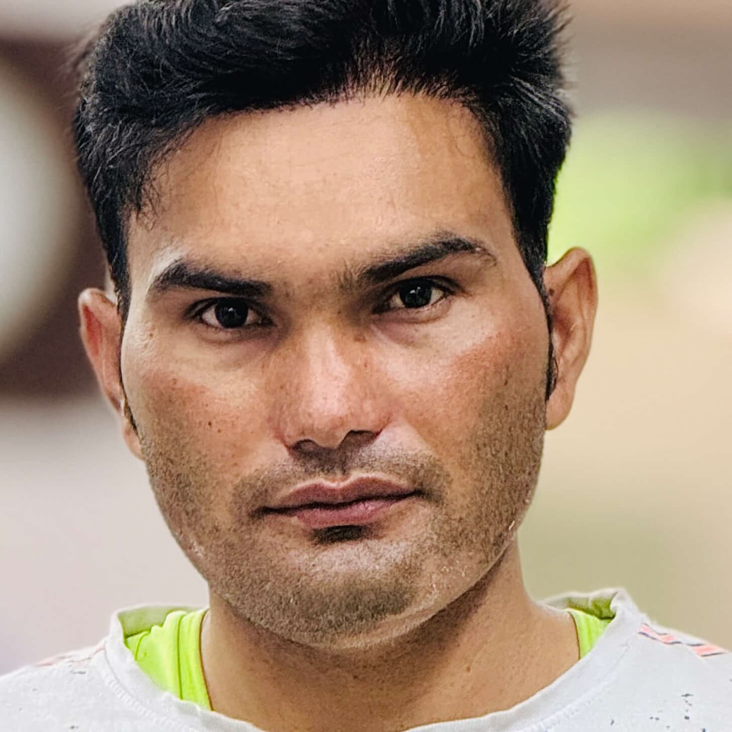 Hair transplant result 14