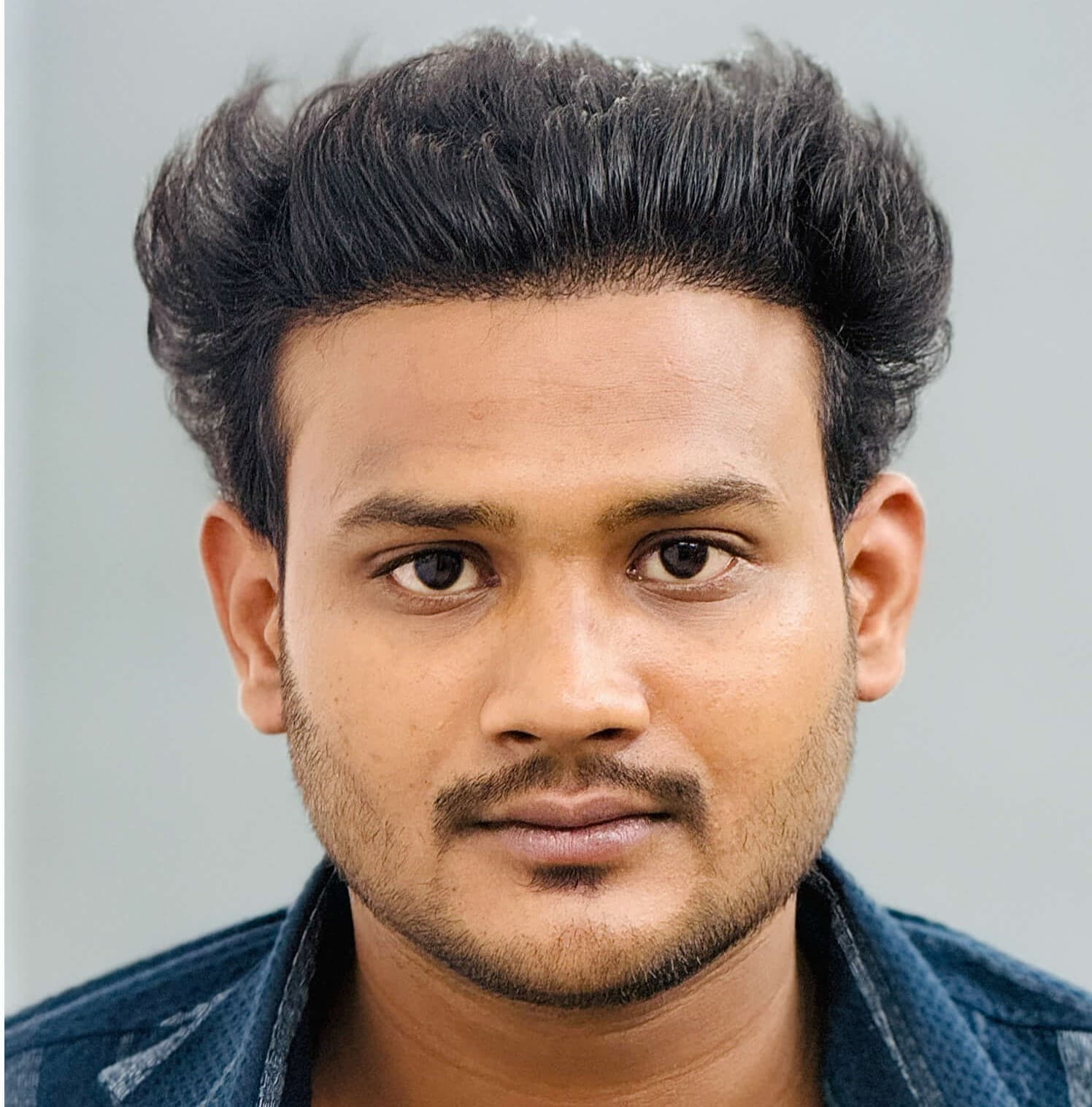 Hair transplant result 3