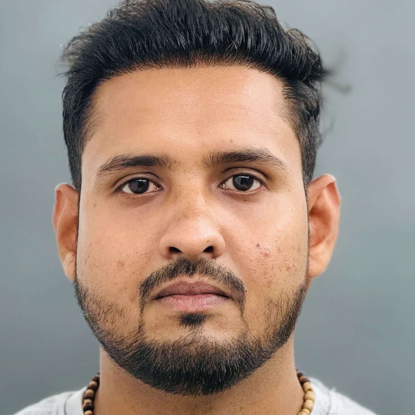 Hair transplant result 5