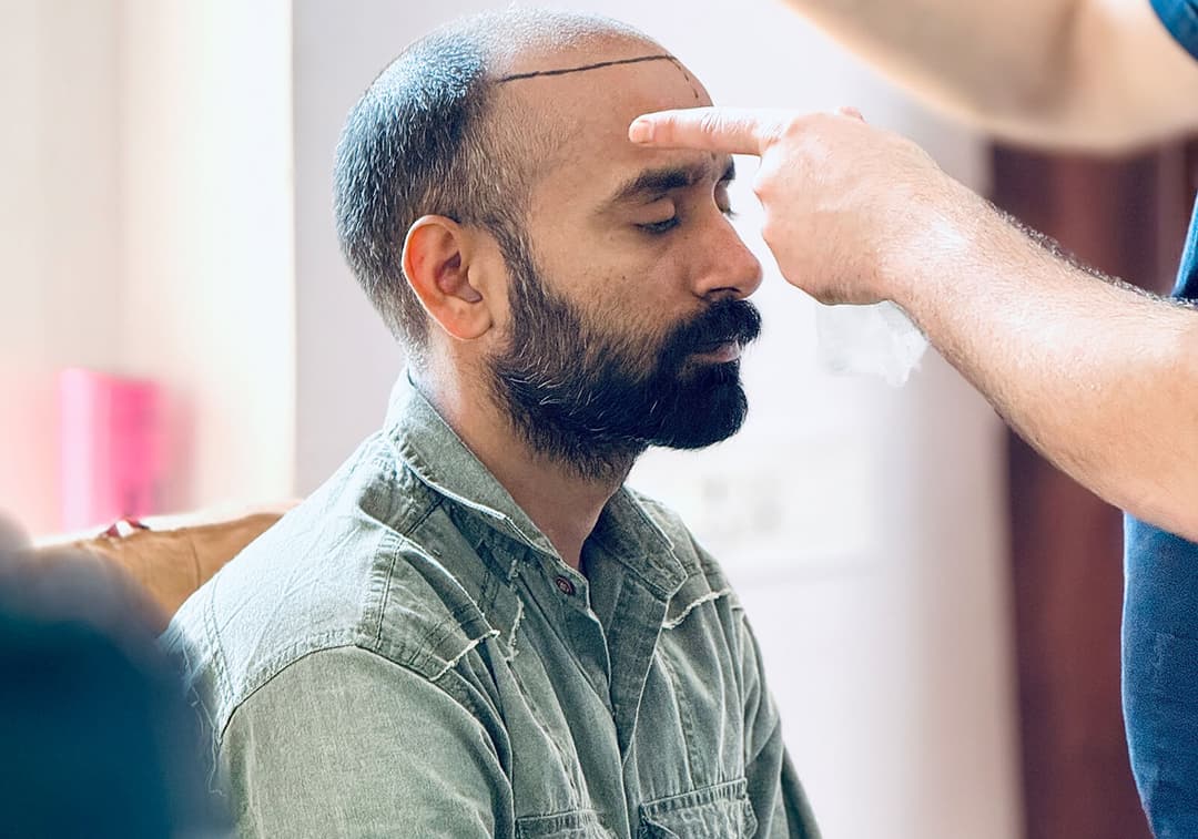 Hair transplant result — Ryan Clinic Mumbai