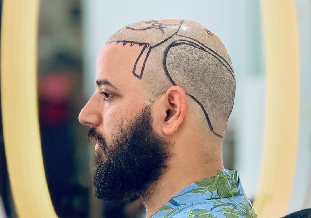 Hair transplant result — Ryan Clinic Mumbai