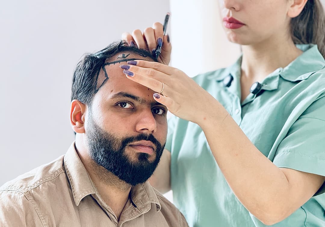 Hair transplant result — Ryan Clinic Mumbai