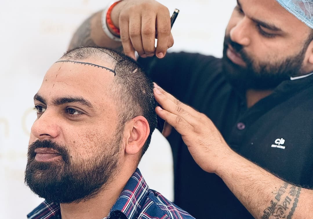 Hair transplant result — Ryan Clinic Mumbai