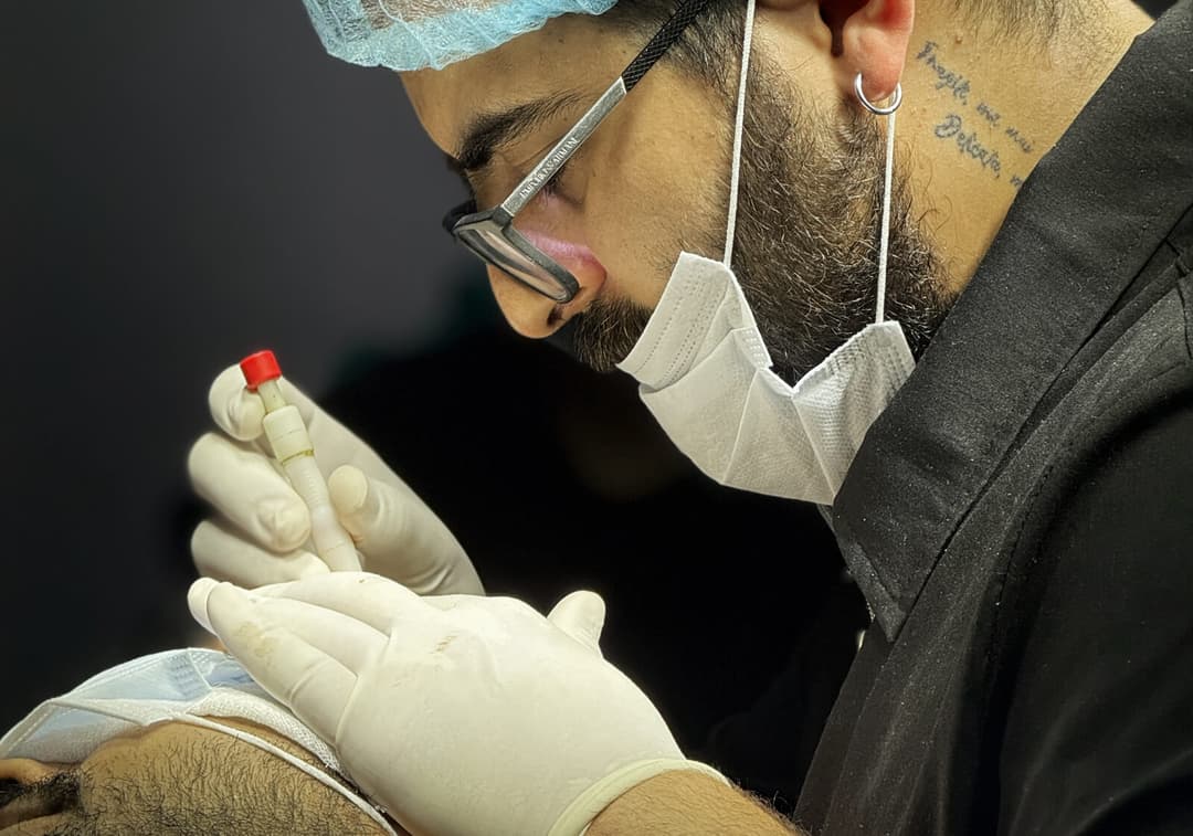 Hair transplant result — Ryan Clinic Mumbai