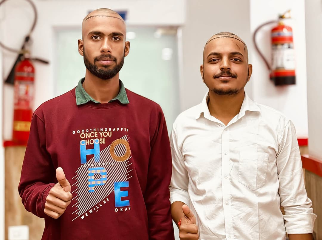 Hair transplant result — Ryan Clinic Hyderabad