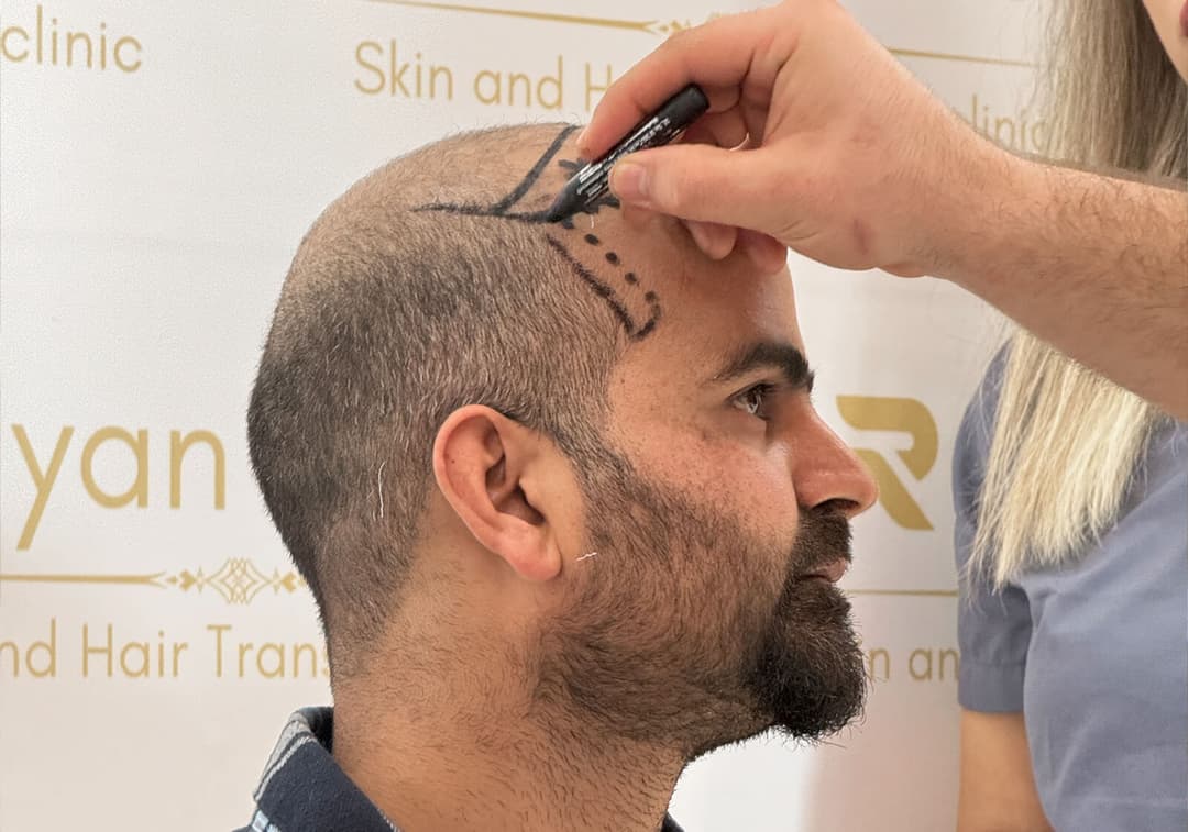 Hair transplant result — Ryan Clinic Delhi