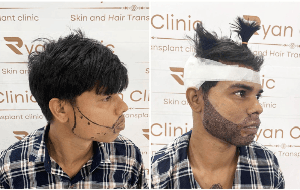 Beard Transplant in Delhi