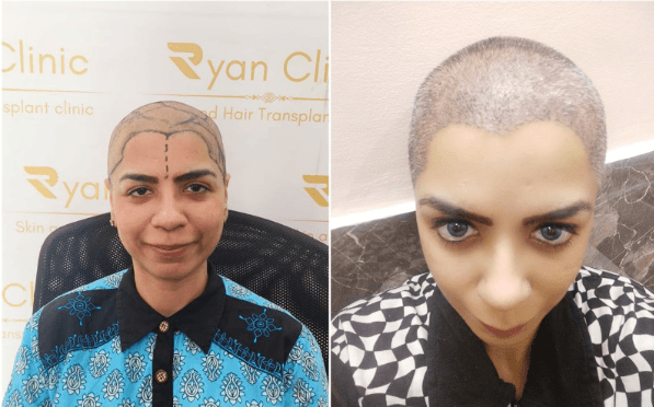 Female Hair Transplant – A Complete Guide to Hair Restoration for Women