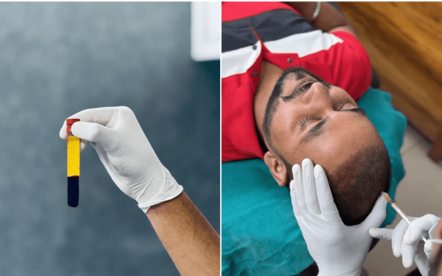 PRP Injections After a Hair Transplant