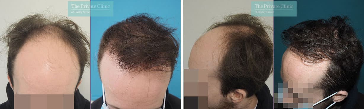 Hair Transplant Grafts: How Many You Need for Natural & Dense Results