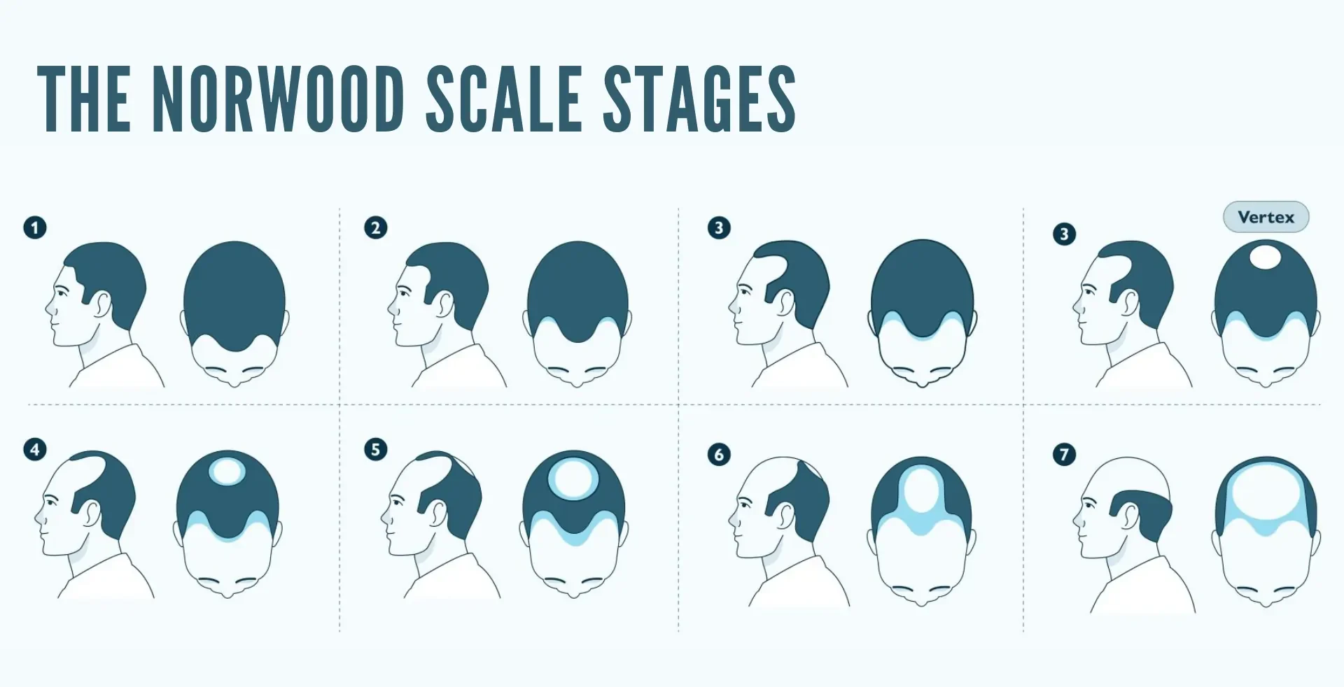Norwood scale chart showing all 7 stages of male pattern baldness