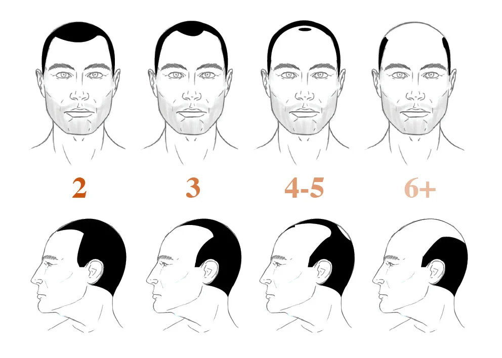 Norwood 2 hairline pattern showing mild symmetrical temple recession