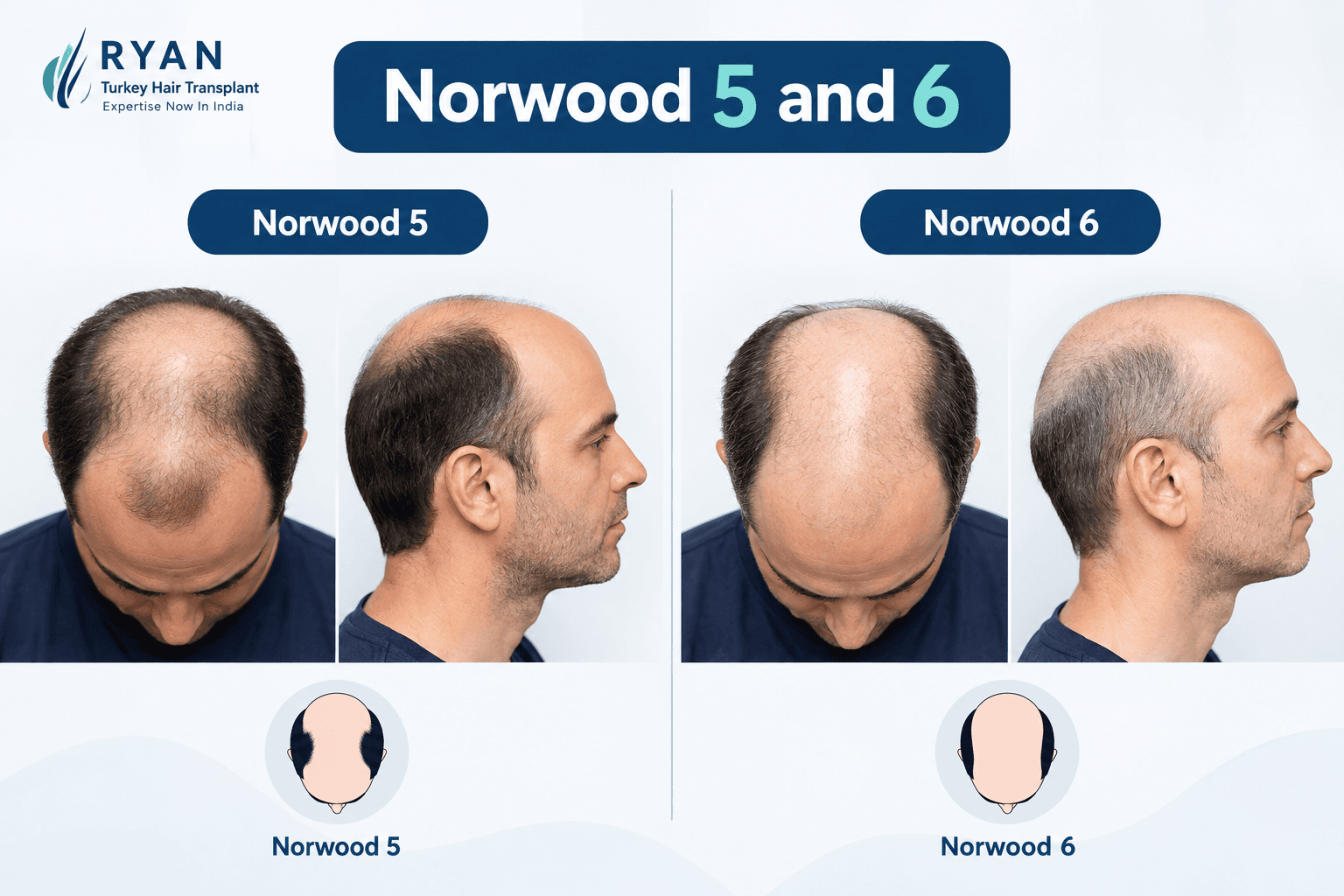 Norwood 5 and Norwood 6 patterns showing bridge loss in advanced baldness