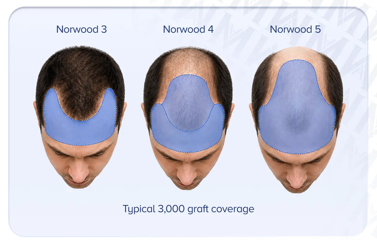 3000 graft hair transplant cost in Delhi explained