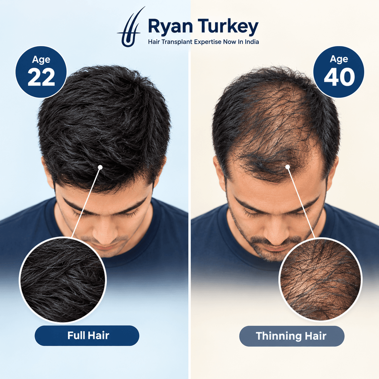 Why a hair transplant at 22 can look wrong by age 40