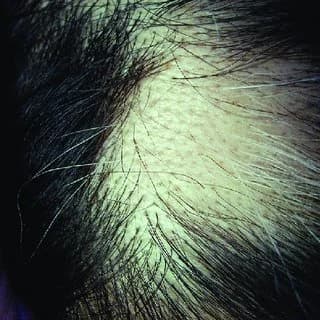 Alopecia areata patch compared with pattern hair loss